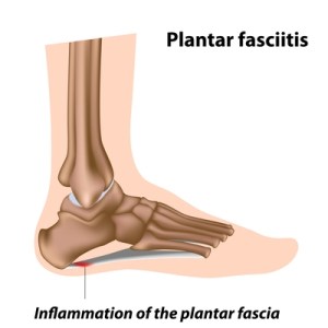 plantar fasciitis